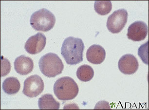 Malaria, vista microscópica de parásitos celulares