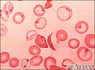 Glóbulos rojos - falciformes y cuerpos de Pappenheimer