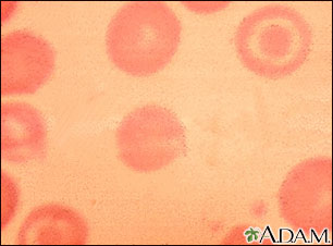 Glóbulos rojos de la sangre, células en diana