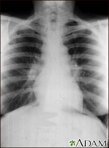 Sarcoidosis, estado I - radiografía de tórax