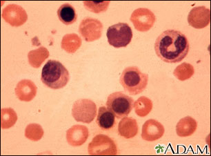 Eritroblastosis fetal - foto micrografía