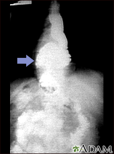 Radiografía de una hernia hiatal
