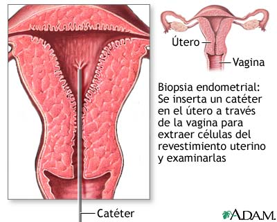 Biopsia endometrial