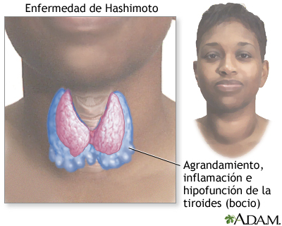 Enfermedad de Hashimoto (tiroiditis crónica)