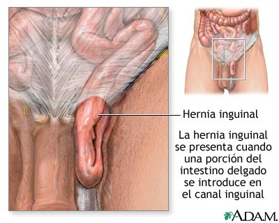 Hernia inguinal