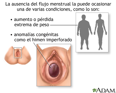 Ausencia de la menstruación (amenorrea)