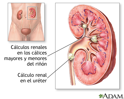 Cálculos renales: MedlinePlus enciclopedia médica