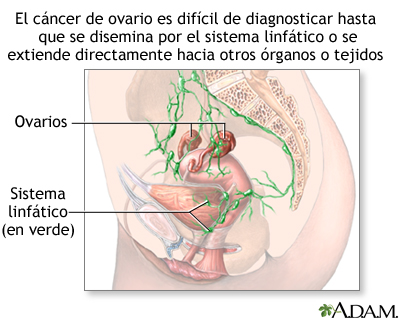 Peligros del cáncer de ovario