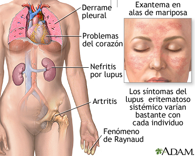 Lupus eritematoso sistémico