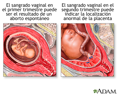 Sangrado vaginal durante el embarazo