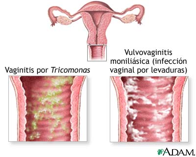 Causas de prurito vaginal