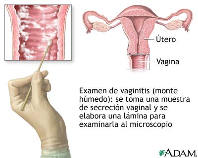 Prueba de vaginitis (montaje húmedo)