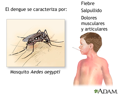 Fiebre por dengue