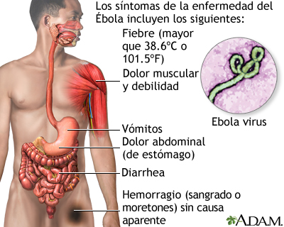Enfermedad por el virus del Ébola