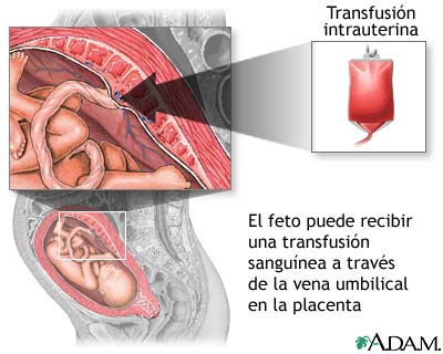 Transfusión intrauterina