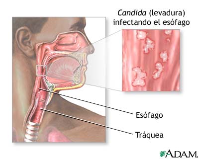Esofagitis por Candida