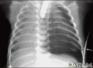Neumotórax - radiografía de tórax