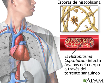 Histoplasmosis diseminada