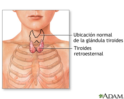Tiroides retroesternal