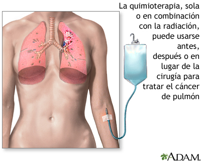 Tratamiento con quimioterapia - cáncer pulmonar