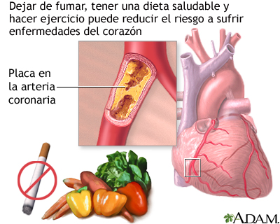 Prevención de la enfermedad cardíaca