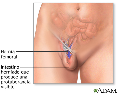 Hernia femoral