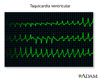 Taquicardia ventricular