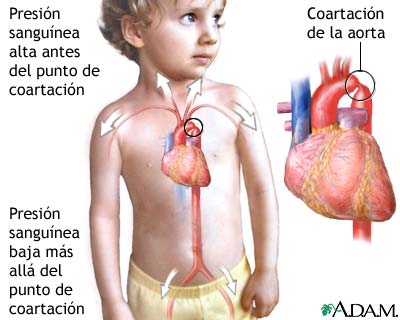 Coartación de la aorta