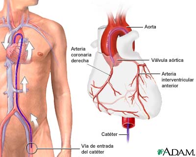 Angiografía coronaria: MedlinePlus enciclopedia médica