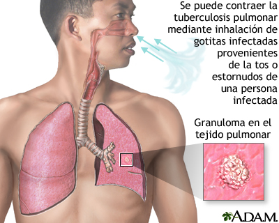 Tuberculosis pulmonar: MedlinePlus enciclopedia médica illustración