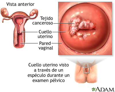 Cáncer cervical