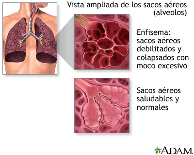 Chispa  chispear Absorbente Estrecho Enfermedad pulmonar obstructiva crónica (EPOC): MedlinePlus enciclopedia  médica illustración