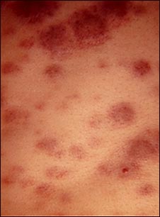 Leucemia monocítica aguda en la piel