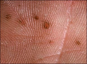 Síndrome de nevo de célula basal - vista de cerca de la palma de la mano