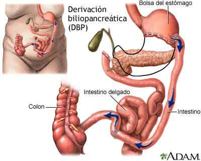 Derivación biliopancreática (BPD)
