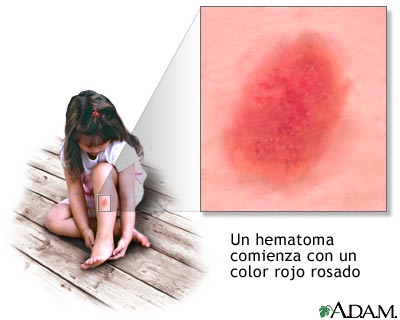 Cicatrización del hematoma - serie