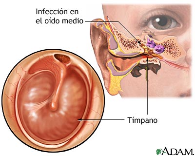 crónica del oído: MedlinePlus enciclopedia médica