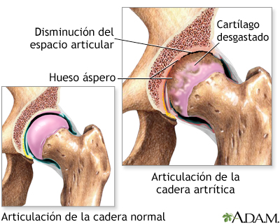 Artritis en la cadera