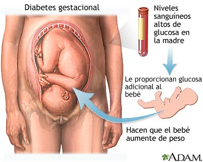 Diabetes gestacional
