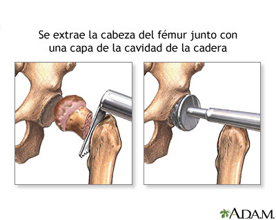 Reparación de la articulación de la cadera desgarrada