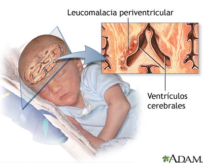 Leucomalacia periventricular