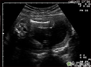 Ultrasonido de un feto normal - medidas del fémur