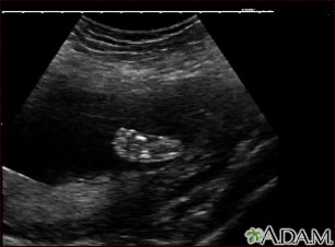 Ultrasonido de un feto normal - pie: MedlinePlus enciclopedia médica  illustración