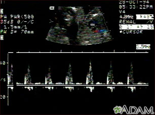 Latidos cardíacos en un ultrasonido de la comunicación interventricular