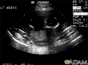 Ultrasonido de un feto normal - ventrículos cerebrales