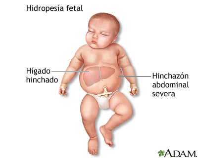 Hidropesía fetal