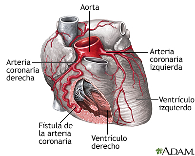 voltaje Consecutivo Demonio Fístula de la arteria coronaria: MedlinePlus enciclopedia médica