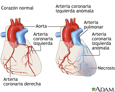 almuerzo valor Tranquilizar Arteria coronaria izquierda anómala desde la arteria pulmonar: MedlinePlus  enciclopedia médica