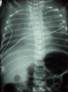 Retorno venoso pulmonar total anómalo - rayos X
