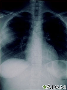 Aspergilosis - radiografía de tórax